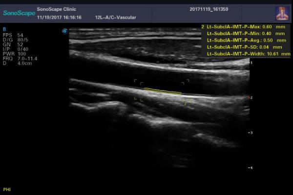 Ecografo E1 EXP Sonoscape